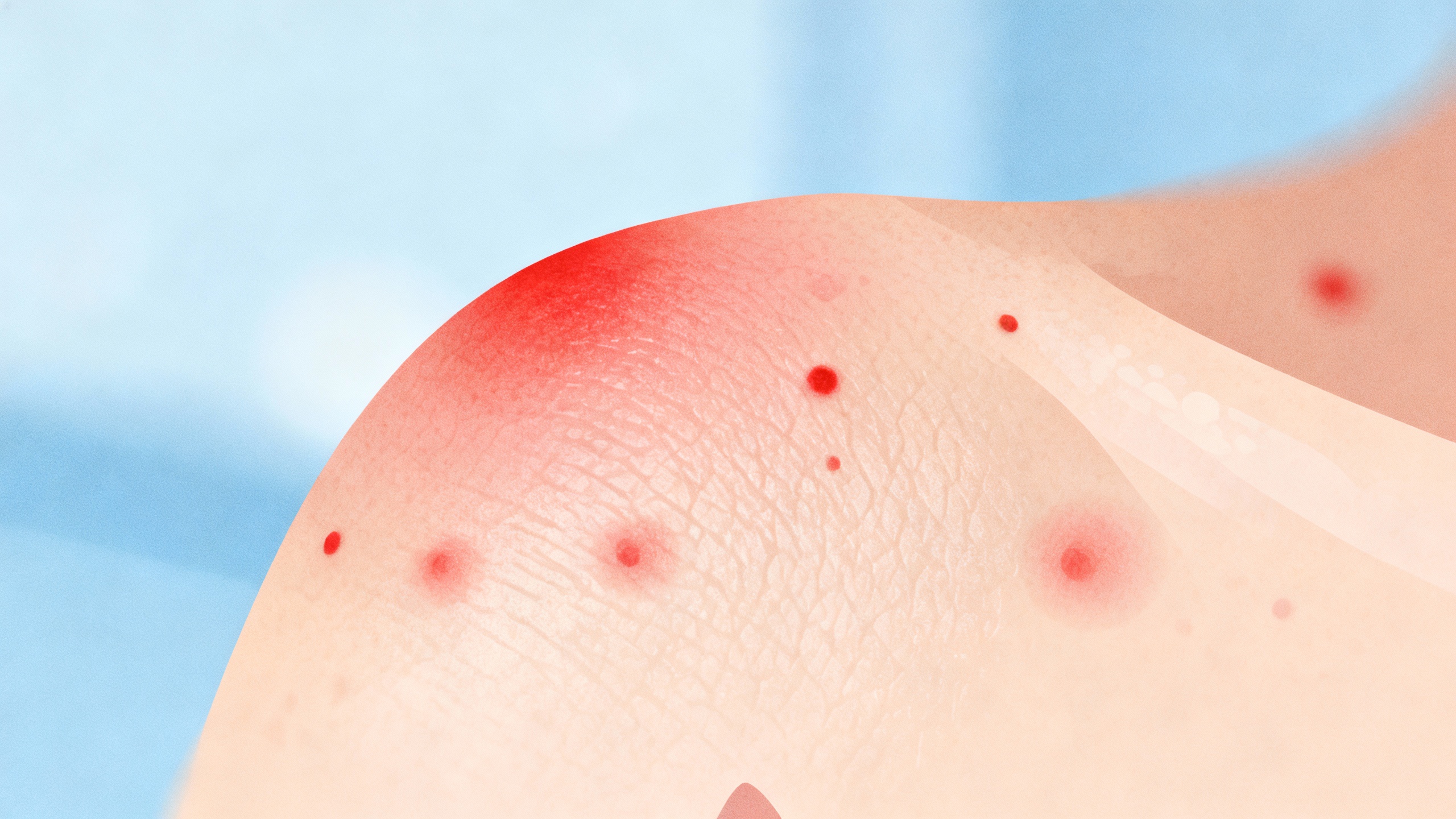 Featured image for What does stress acne look like?